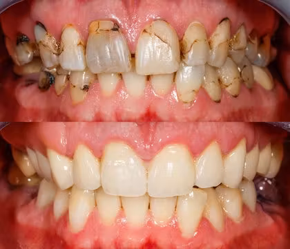 Close-up of teeth showing improvement after using the trick